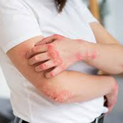 চর্মরোগের ক্রিম